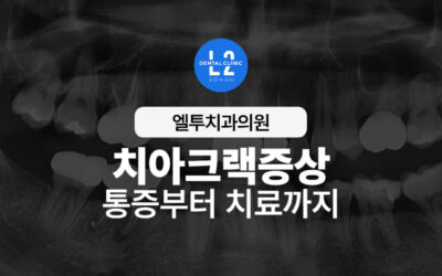 치아크랙증상, 통증부터 치료까지 꼭 알아야 할 모든 것