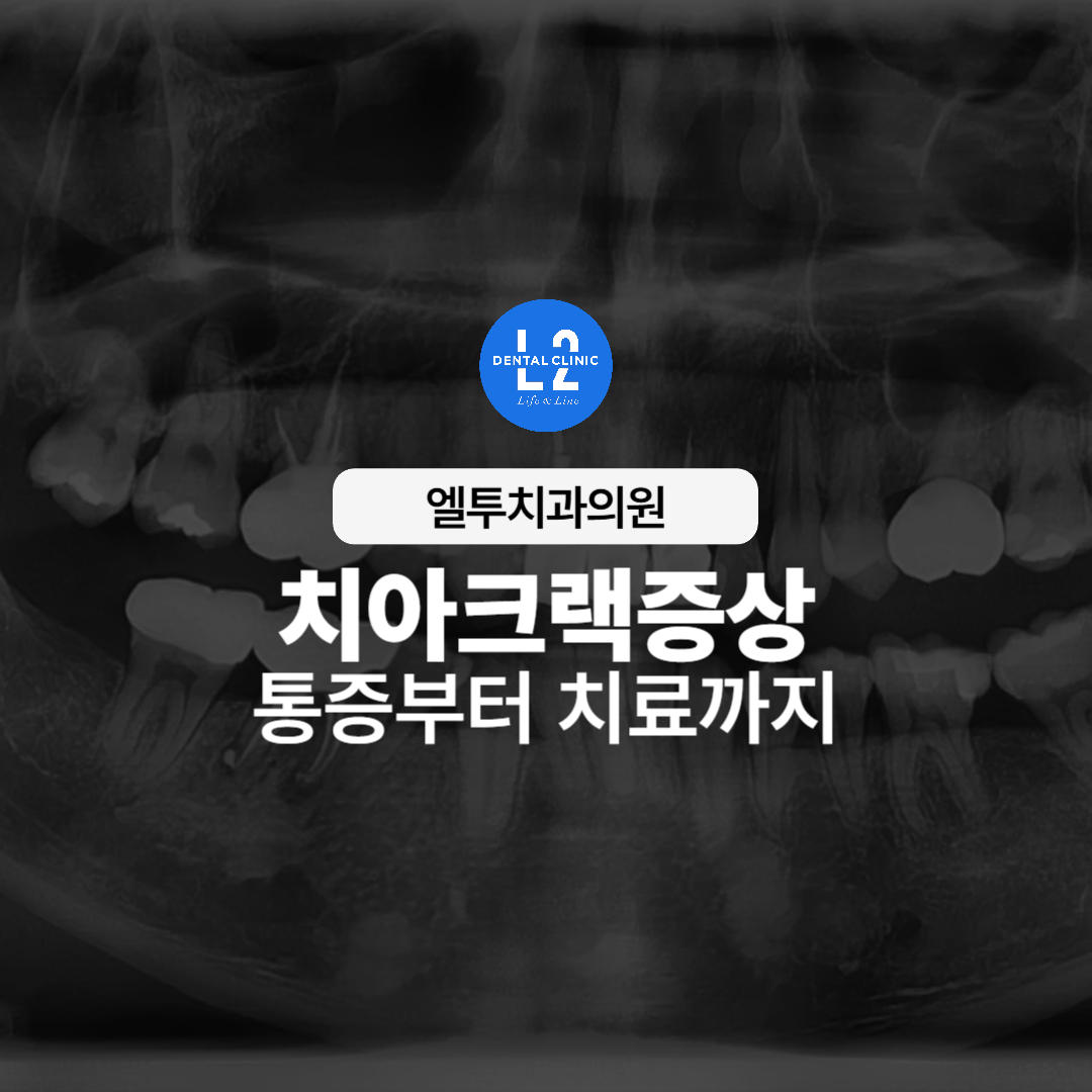 치아 엑스레이 사진과 치아크랙증상 안내 문구