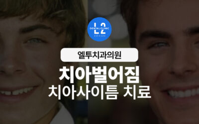 치아벌어짐 치아사이틈 치료,  원인과 개선 방법