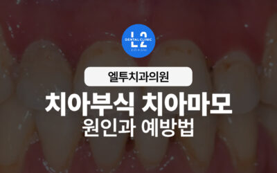 치아부식 치아마모, 왜 생기고 어떻게 예방할까?