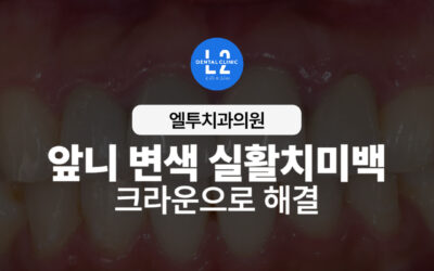 앞니 변색 실활치미백과 크라운으로 해결