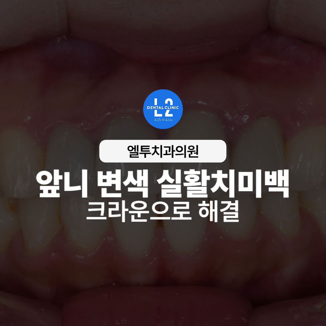 앞니 변색으로 인한 치아 색상 변화