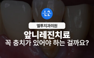 앞니레진치료 꼭 충치가 있어야 하는 걸까요?