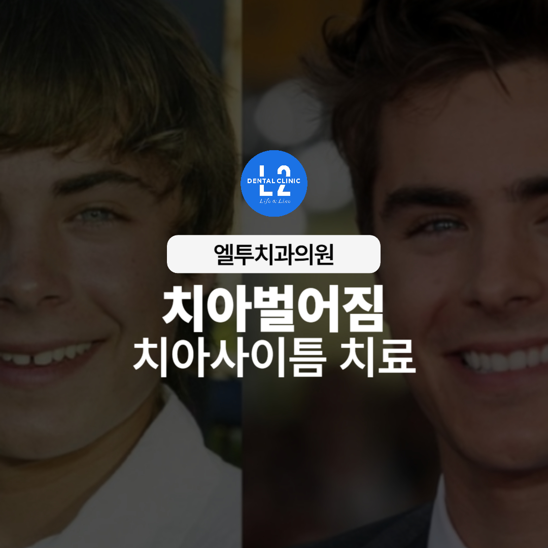 치아벌어짐과 치아사이틈 치료 전후 모습