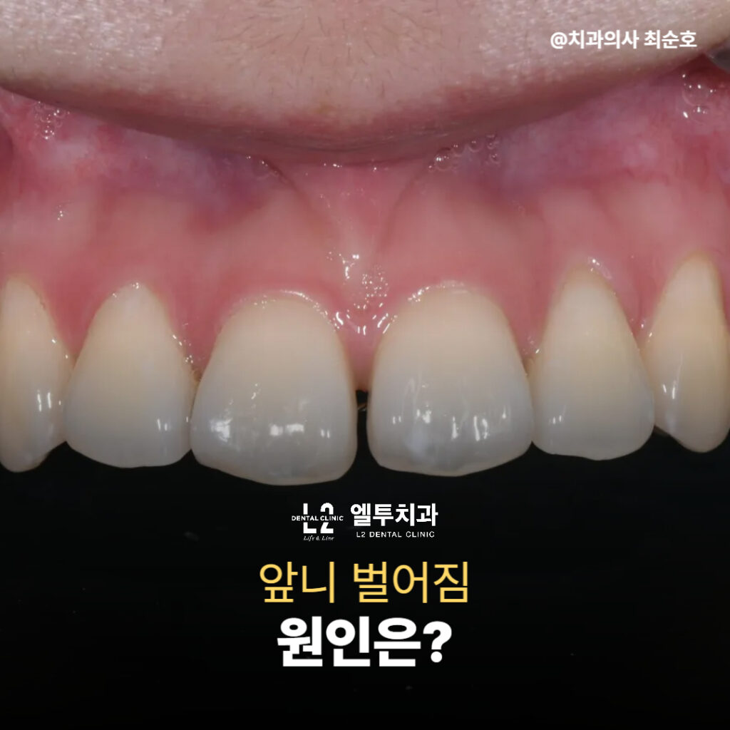 앞니 벌어짐 원인을 보여주는 환자 구강 사진