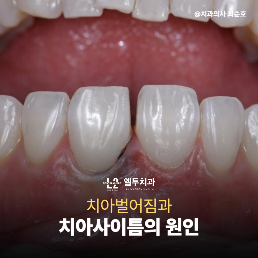앞니 치아벌어짐과 치아사이틈 원인