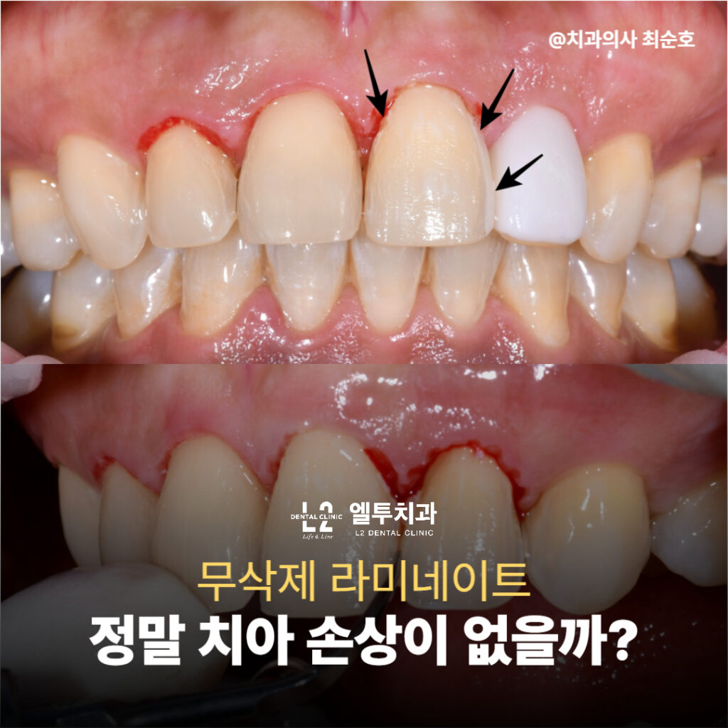 무삭제 라미네이트 후 치아 손상 여부를 보여주는 전후 사진