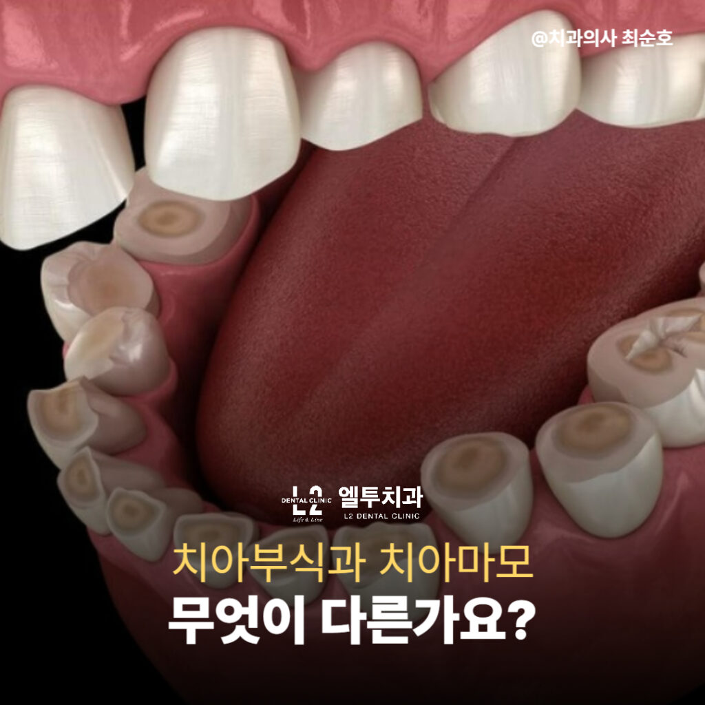 어금니와 앞니가 닳고 패인 모습을 보여주는 3D 구강 모형 이미지