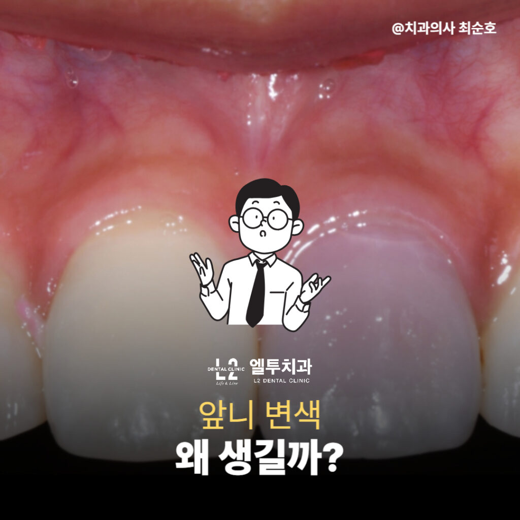 신경치료로 인해 변색된 치아와 실활치미백 전 모습