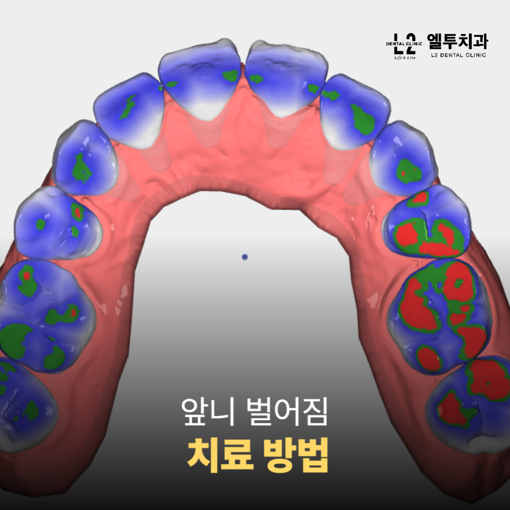 앞니 벌어짐 치료 방법을 시뮬레이션한 3D 치과 이미지