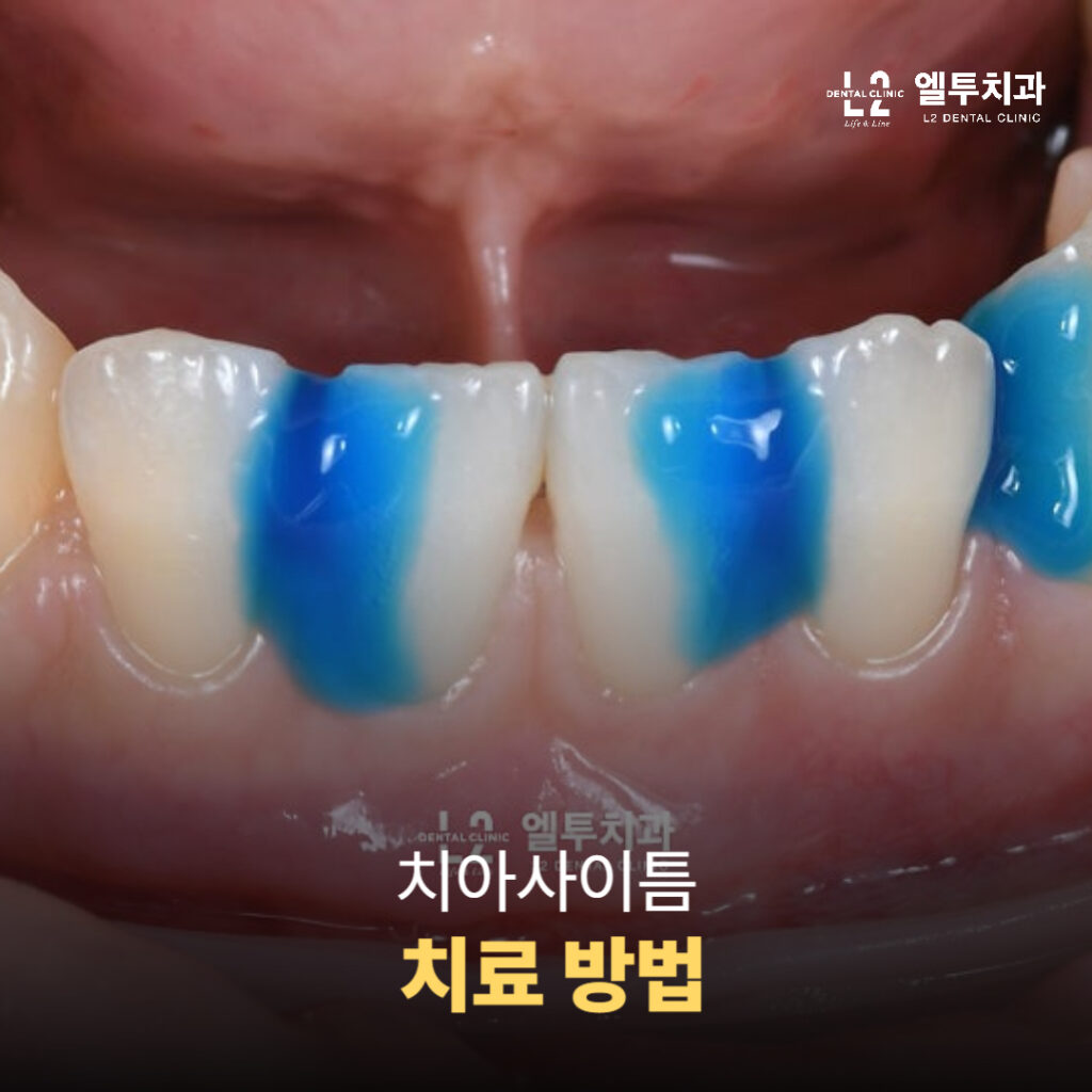 치아사이틈 레진 치료 과정