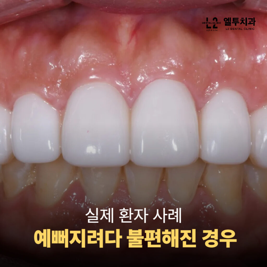 무삭제 라미네이트 시술 후 인조적인 느낌이 생긴 실제 환자 사례