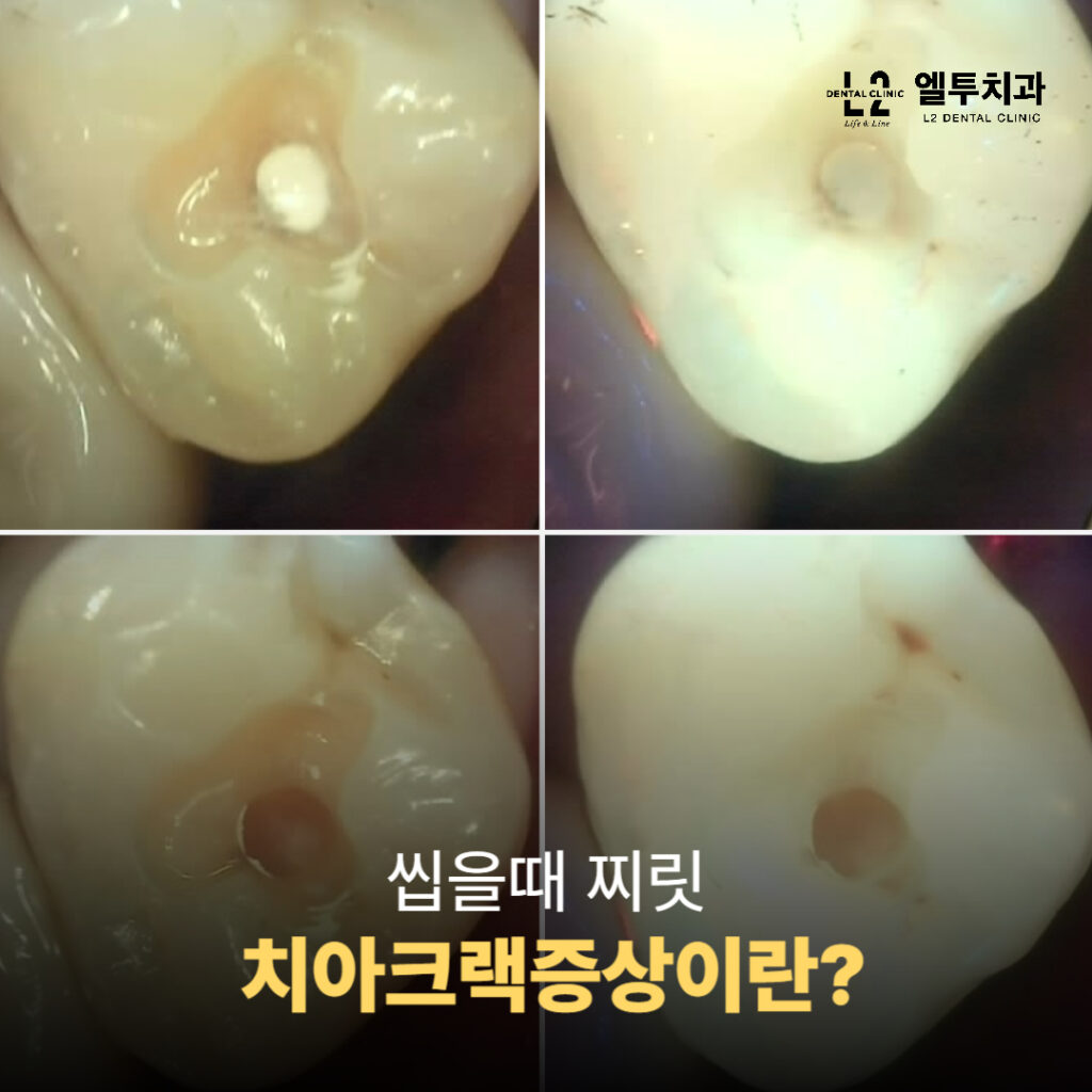 어금니 치아 표면에 금이 간 모습 확대 사진
