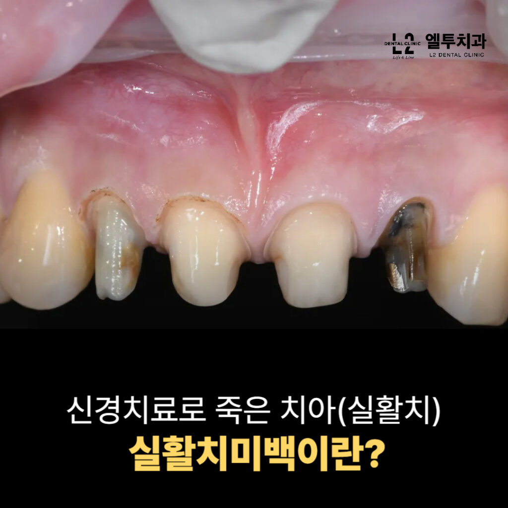 앞니 변색 및 크라운 치료 전후 비교 사례