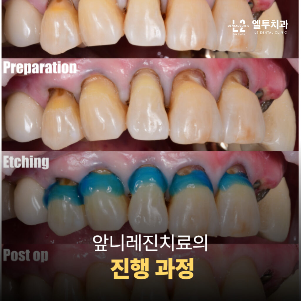 앞니레진치료 과정(Preparation, Etching, Post op)을 단계별로 보여주는 이미지