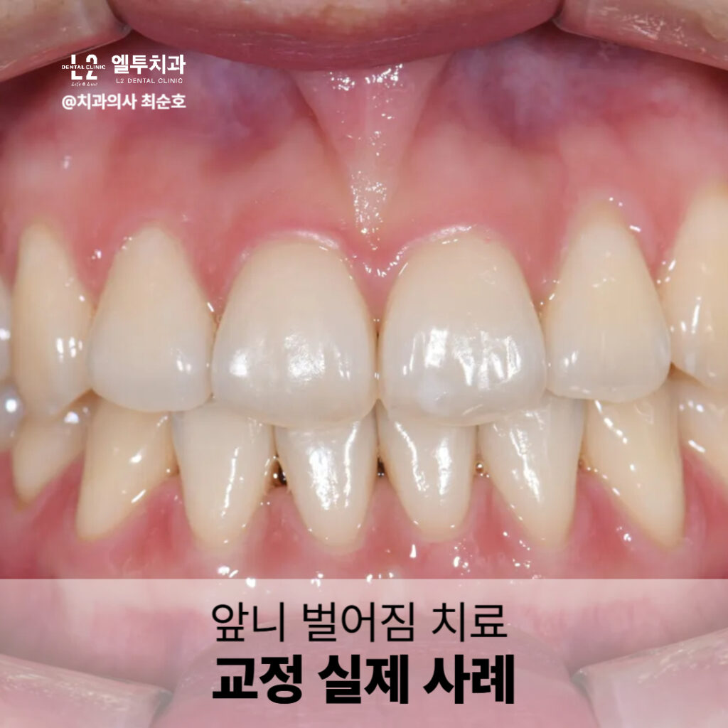앞니 벌어짐 교정 치료 실제 사례 구강 사진