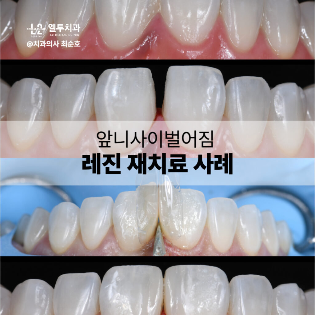 앞니사이벌어짐 레진 재치료 사례