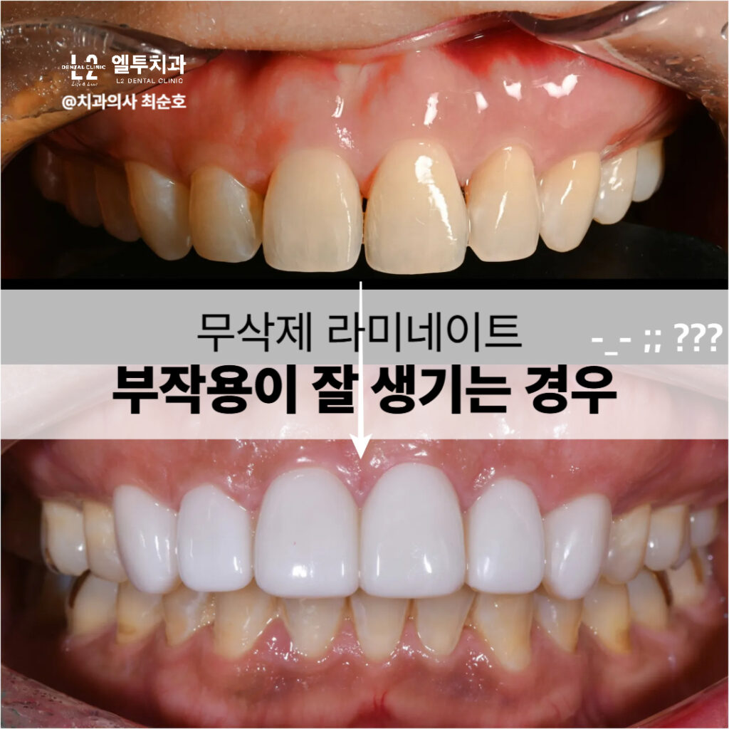 무삭제 라미네이트 부작용이 발생한 사례 비교 이미지