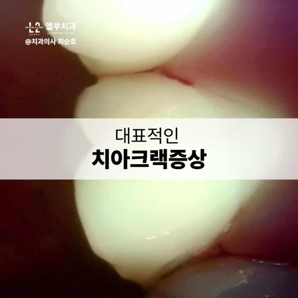 치아 사이에 생긴 금이 보이는 사진