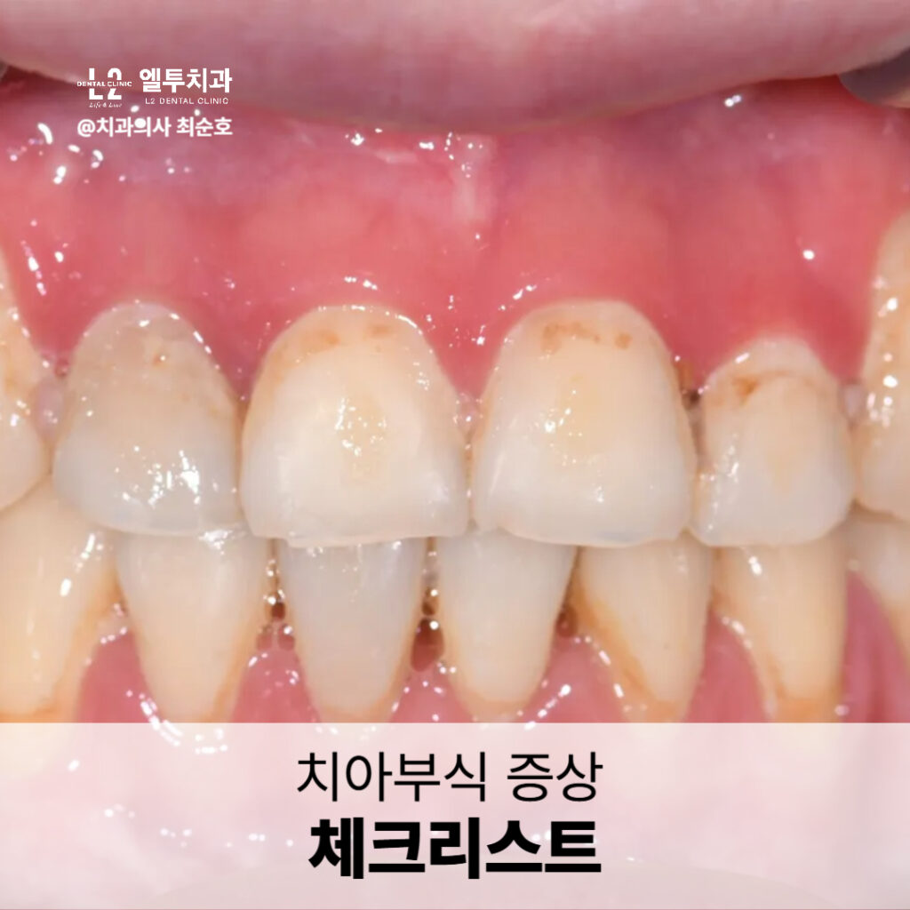 앞니 잇몸 부위에 착색과 패임이 보이는 환자의 구강 내 사진