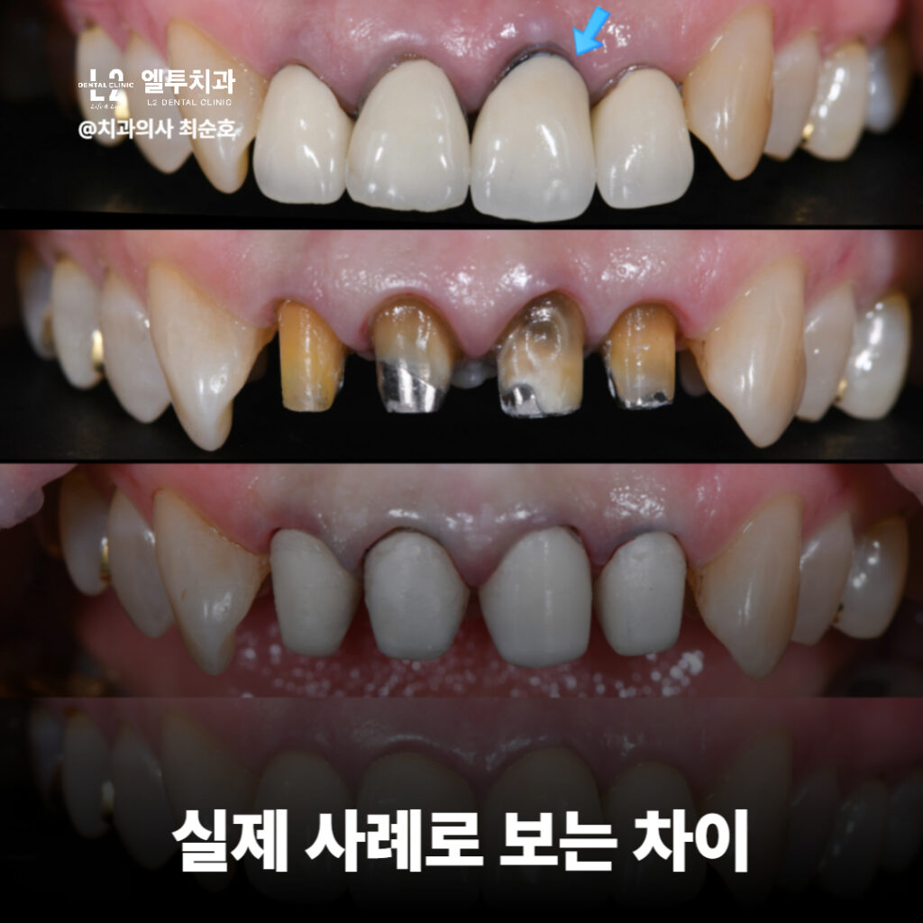 앞니 변색 개선을 위한 실활치미백과 크라운치료 소개
