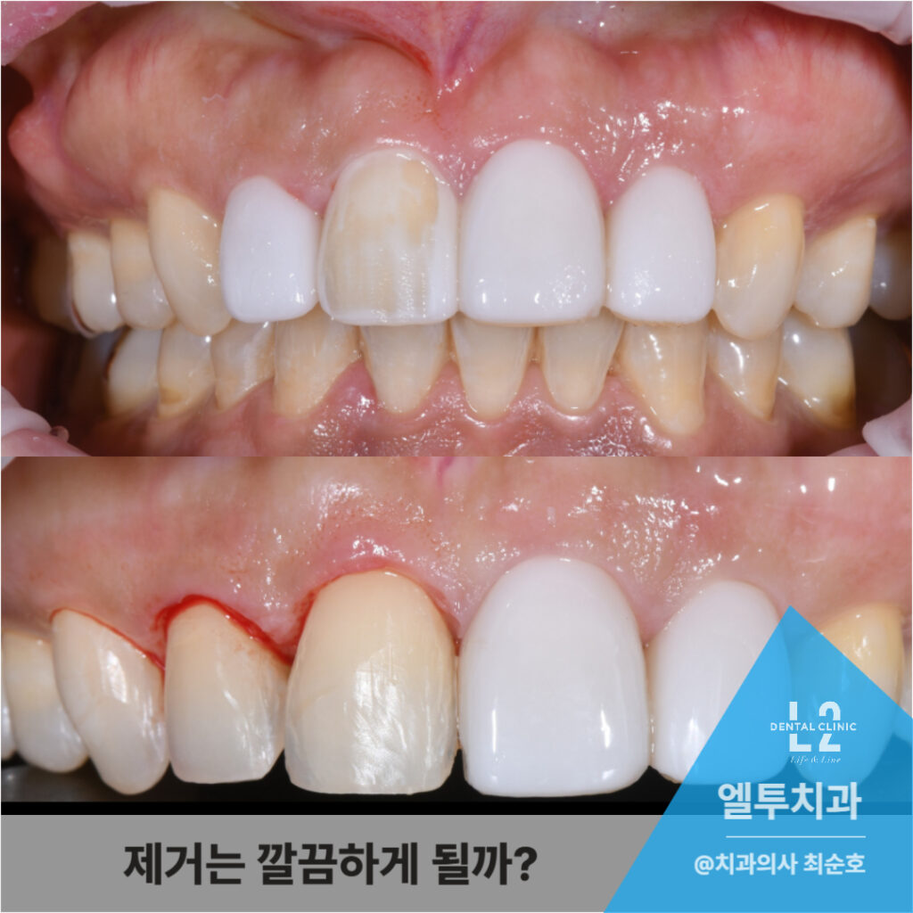 무삭제 라미네이트 제거 후 치아 상태 변화 이미지
