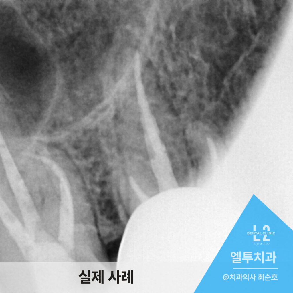 치아 뿌리와 신경 부위를 확인하는 치과 엑스레이 사진