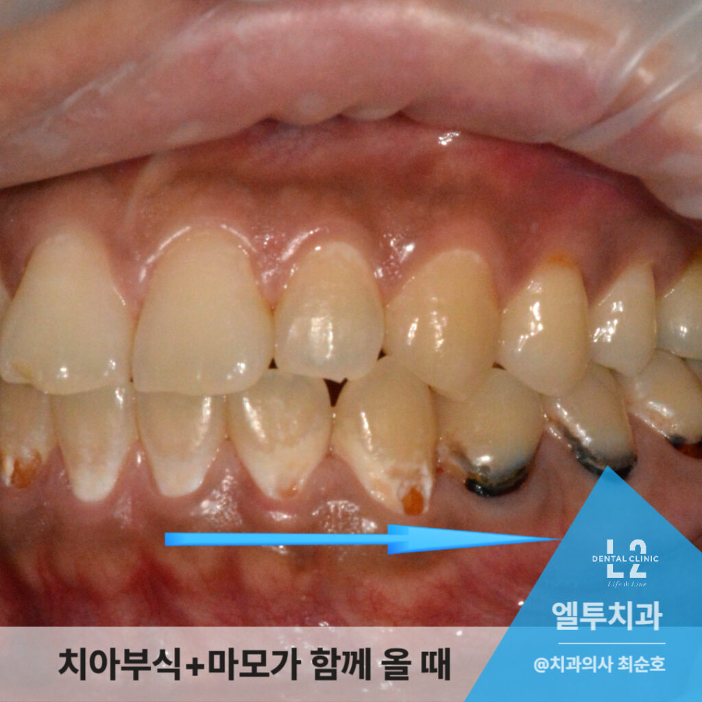 치아 끝과 옆면이 심하게 닳고 패여 있는 환자의 구강 내 사진