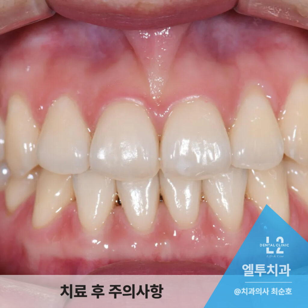 치료 후 자연스럽게 개선된 앞니