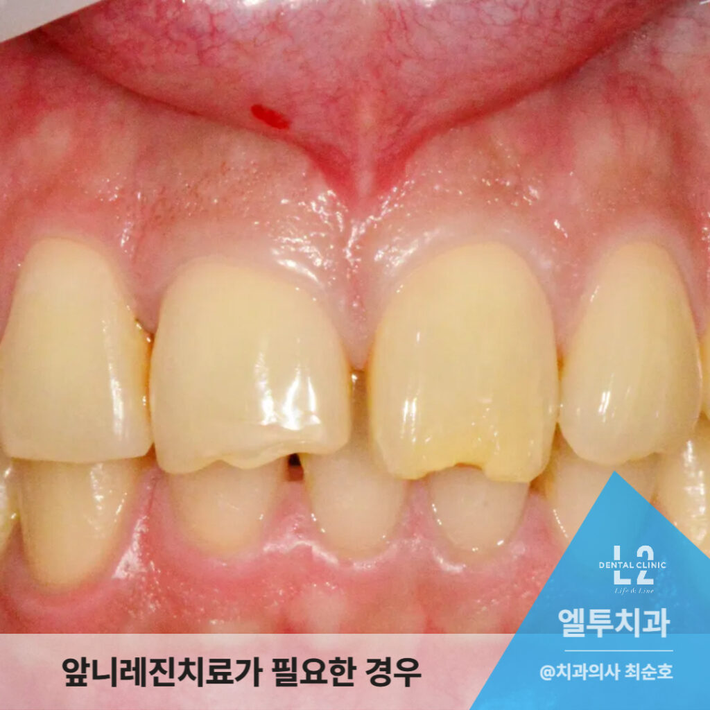 앞니 깨짐과 패임으로 인해 레진치료가 필요한 실제 사례 치아 사진