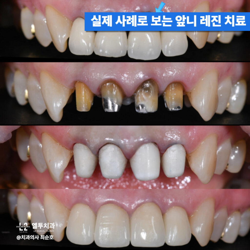 앞니 레진 치료 전후 비교 사진