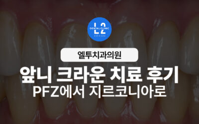 앞니 크라운 치료 후기 인조적인 PFZ에서 자연스러운 지르코니아로