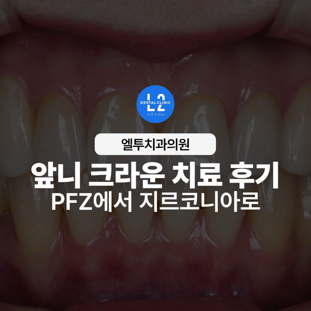 앞니 PFZ 크라운을 지르코니아 크라운으로 교체한 치료 사례의 대표 이미지