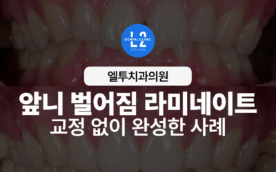 앞니 벌어짐 라미네이트, 교정 없이 완성한 사례