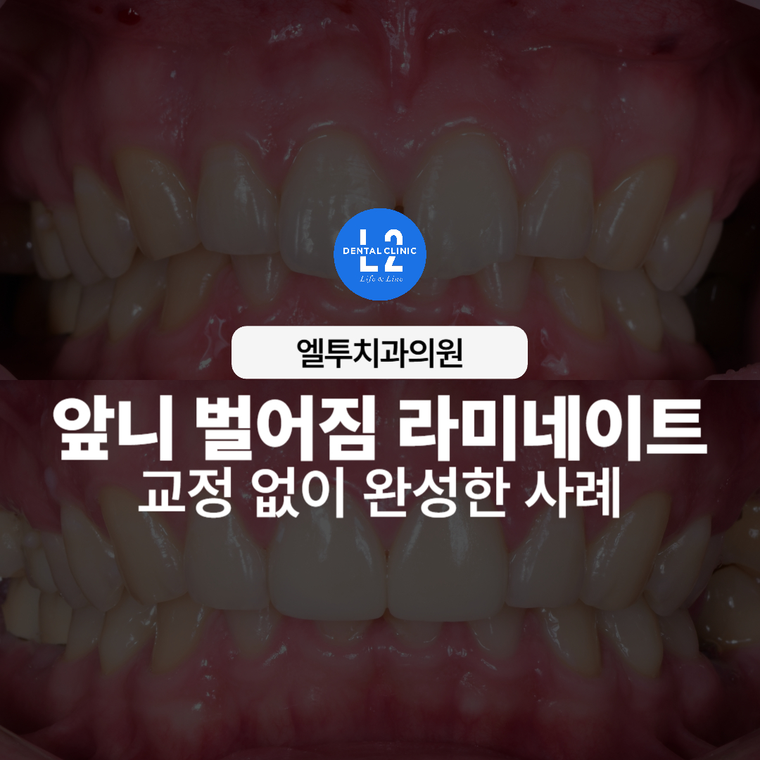 교정 없이 앞니 벌어짐을 라미네이트로 개선한 치료 사례 대표 이미지