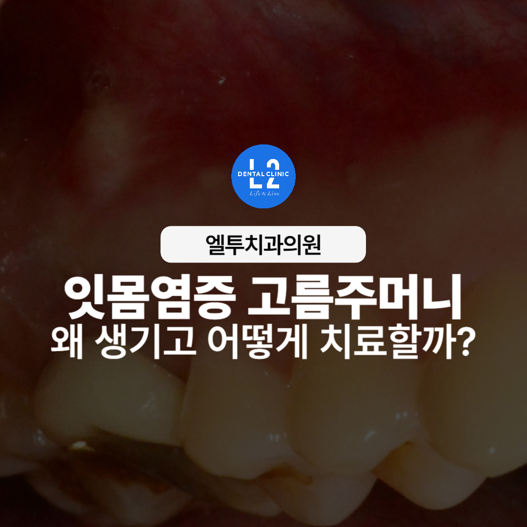 잇몸염증으로 인한 고름주머니 치료 사례 대표 이미지
