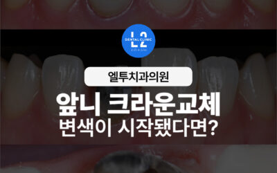 앞니 크라운교체, 변색이 시작됐다면 서둘러야 하는 이유