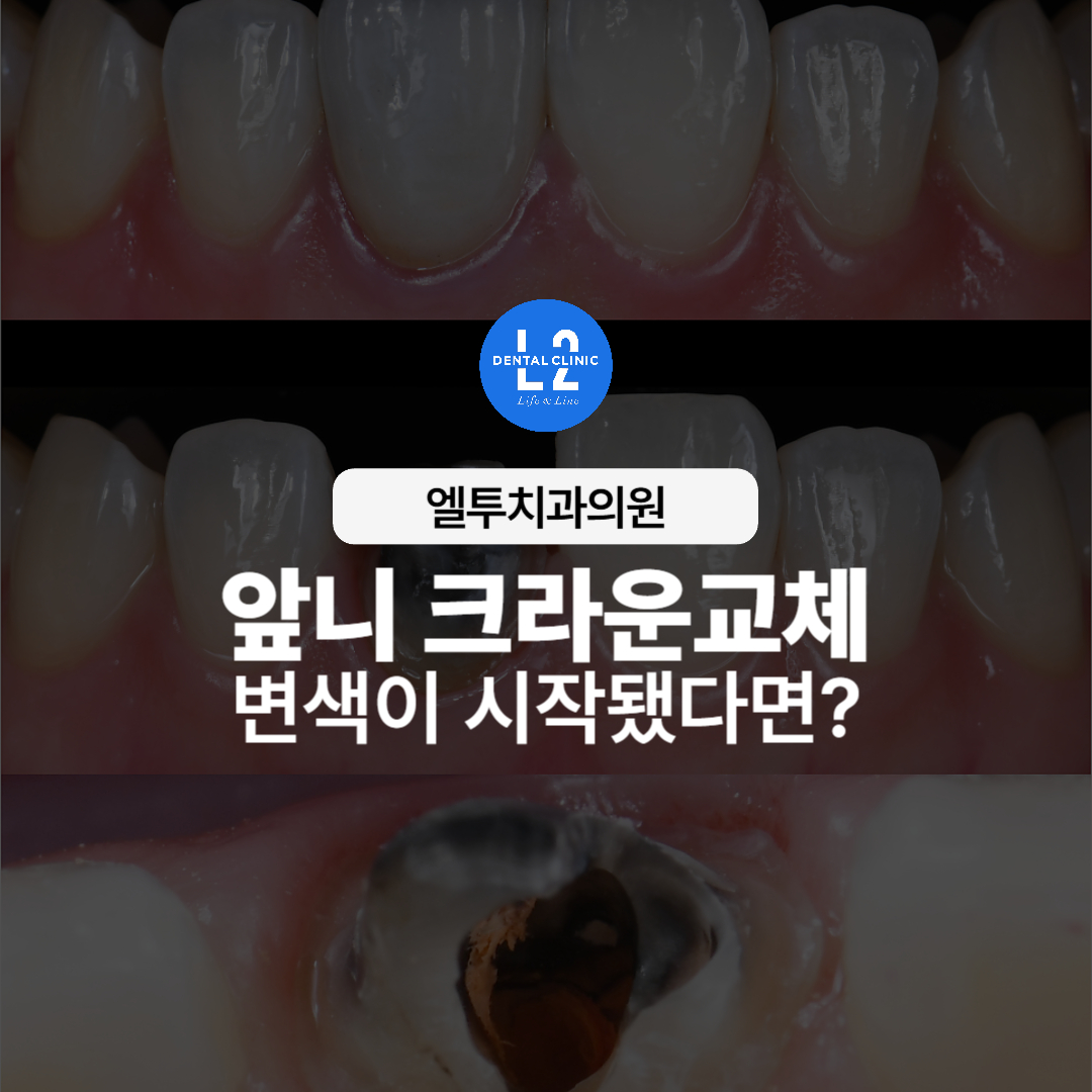 앞니 크라운교체 치료 전후 모습과 변색된 치아 이미지