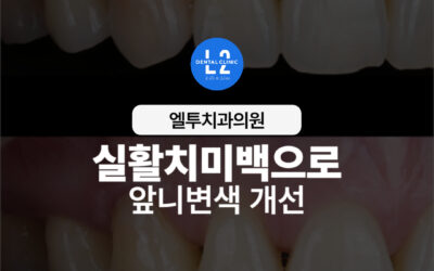 실활치미백으로 앞니변색 개선 레진코어로 자연 복원