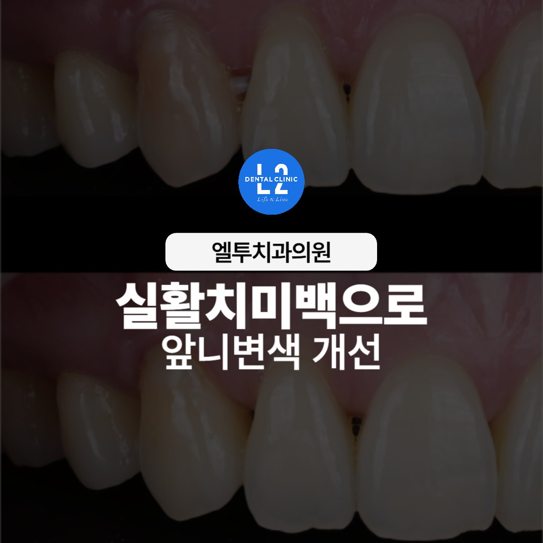 실활치미백 앞니변색 레진코어 치료로 밝고 자연스럽게 개선된 송곳니 전후 모습