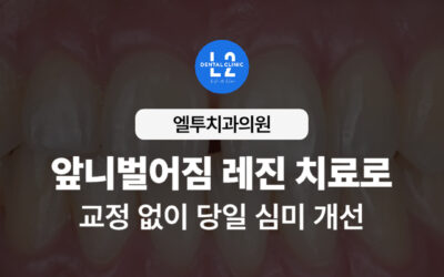 앞니벌어짐 레진 치료로 교정 없이 당일 심미 개선