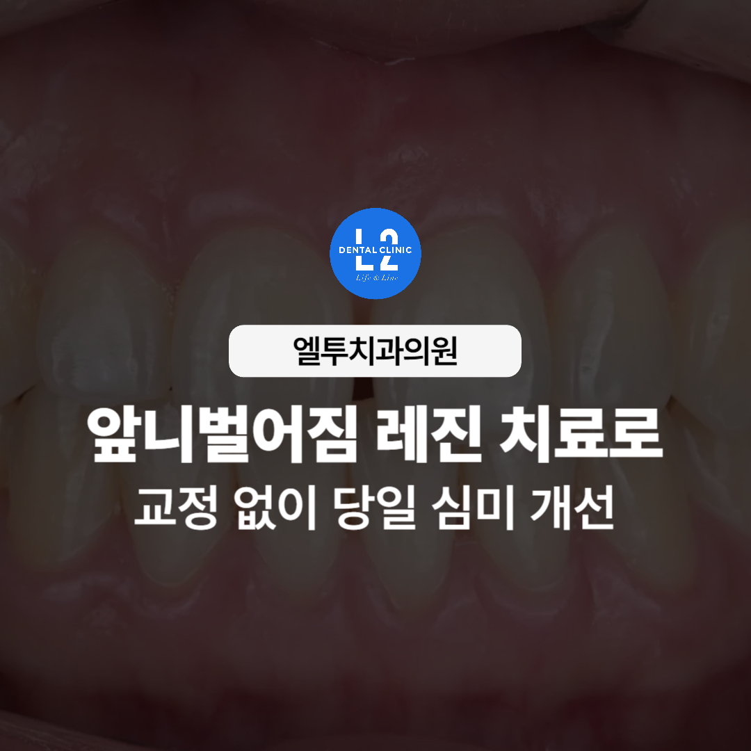 앞니벌어짐 레진 치료 방법 비교를 설명하는 치아 사진