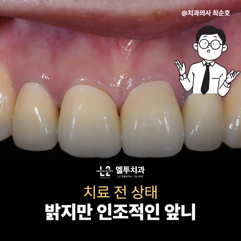 PFZ 크라운으로 수복된 앞니의 밝지만 인조적인 모습