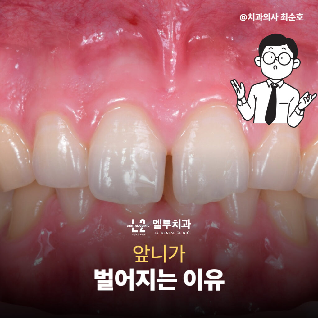 앞니 사이에 간격이 생긴 정중이개(Diastema) 상태의 치아