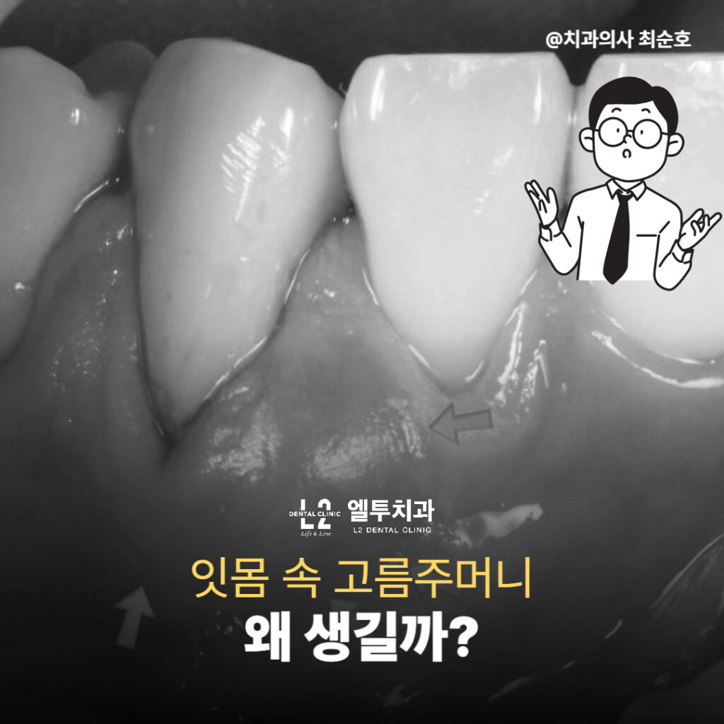 잇몸 속에 생긴 고름주머니 위치를 표시한 치아 이미지