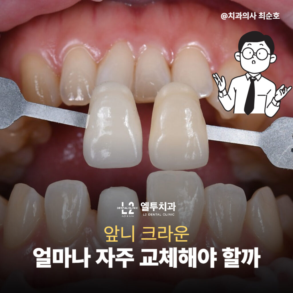 앞니 크라운 색상 비교를 위한 쉐이드 가이드 측정 장면
