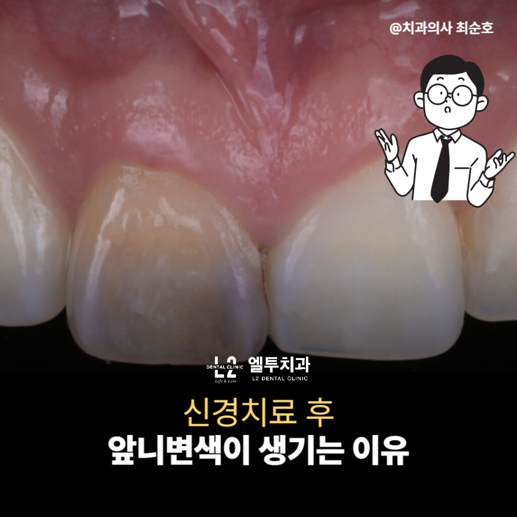 신경치료 후 앞니변색이 생긴 치아의 초기 상태 사진