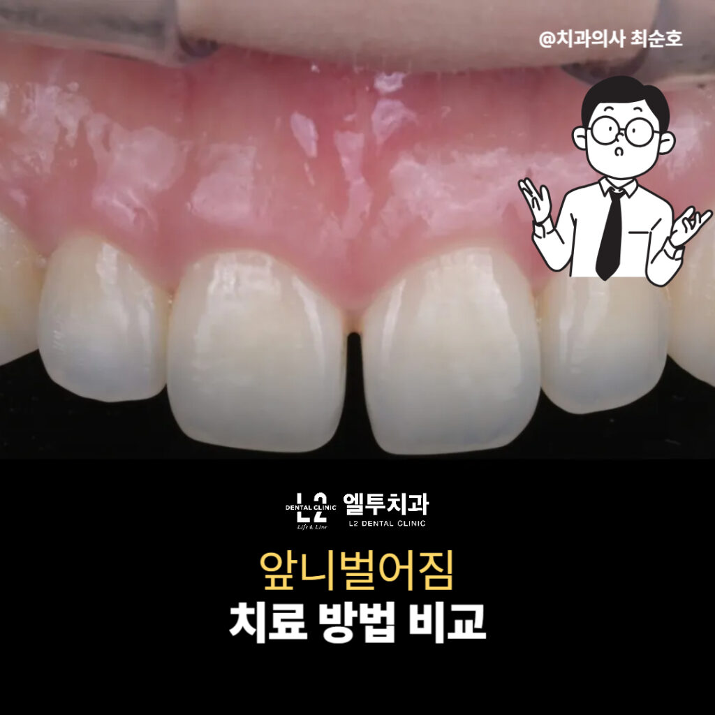 앞니벌어짐 레진 치료의 원리를 보여주는 치아 클로즈업 사진