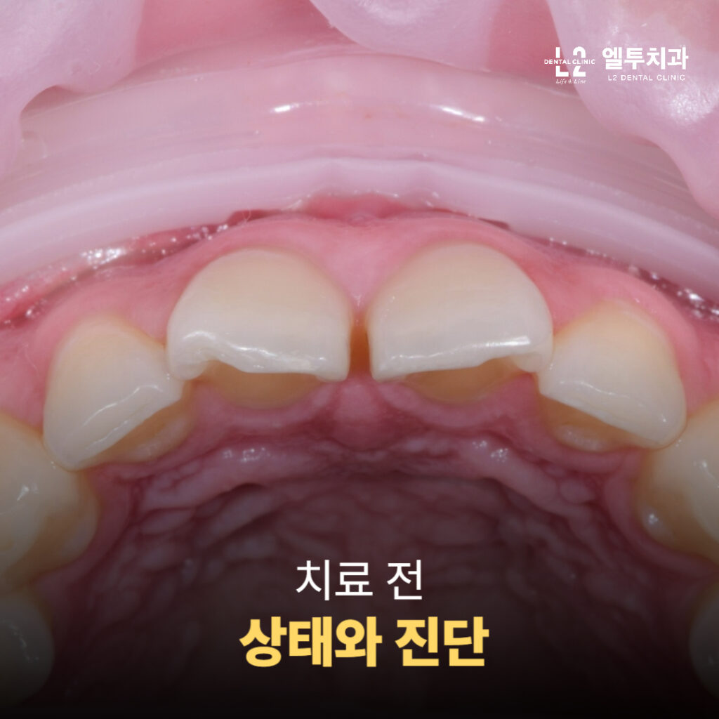 앞니 벌어짐과 치아 깨짐이 함께 나타난 치료 전 상태