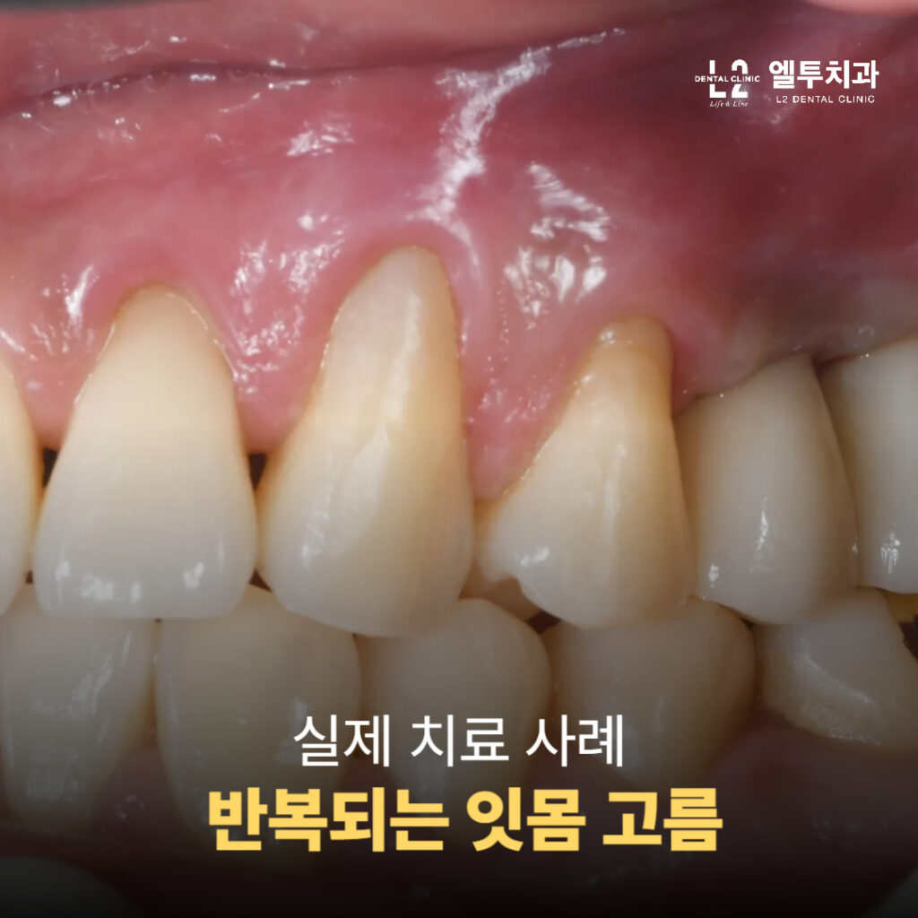 잇몸이 부풀고 고름이 반복적으로 발생한 실제 환자 사례